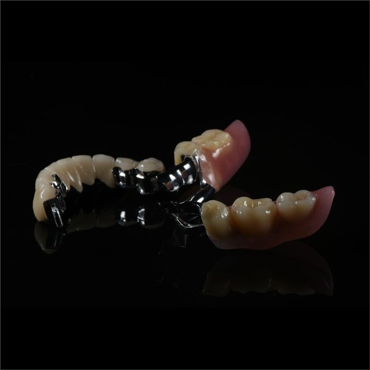 PFM Precision Crowns With Partial Dentures