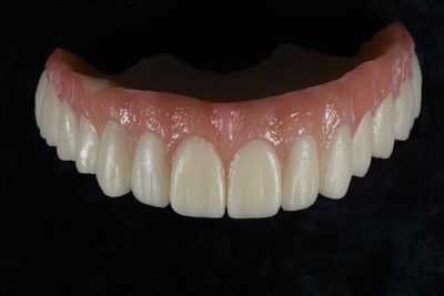 Coroa temporária de resina acrílica